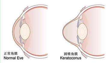 圆锥角膜最新治疗,圆锥角膜最新治疗进展及其影响